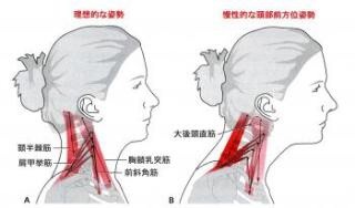 肩こりの筋肉